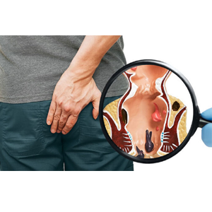 Gây viêm nhiễm cho hậu môn